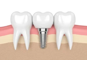 dental implants mascot